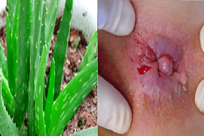hemoroid tedavisi için aloe
