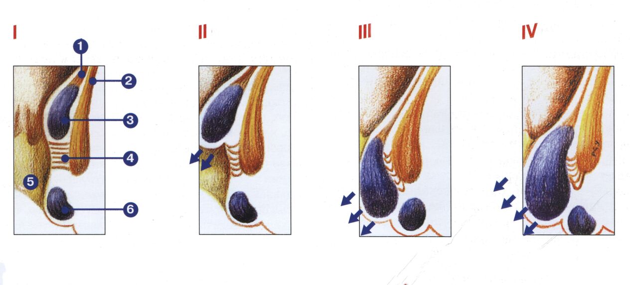 hemoroit gelişiminin aşamaları