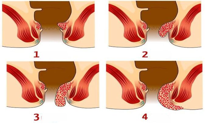 hemoroitlerin farklı aşamalarda neye benzediği